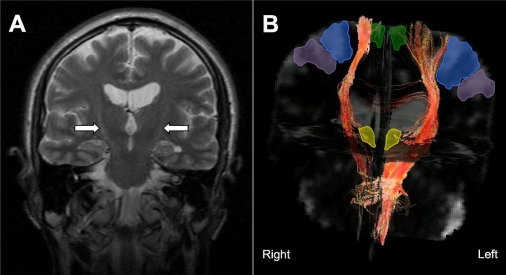 Scientific illustration of neurons and synapses representing SPG302’s regenerative approach for ALS treatment