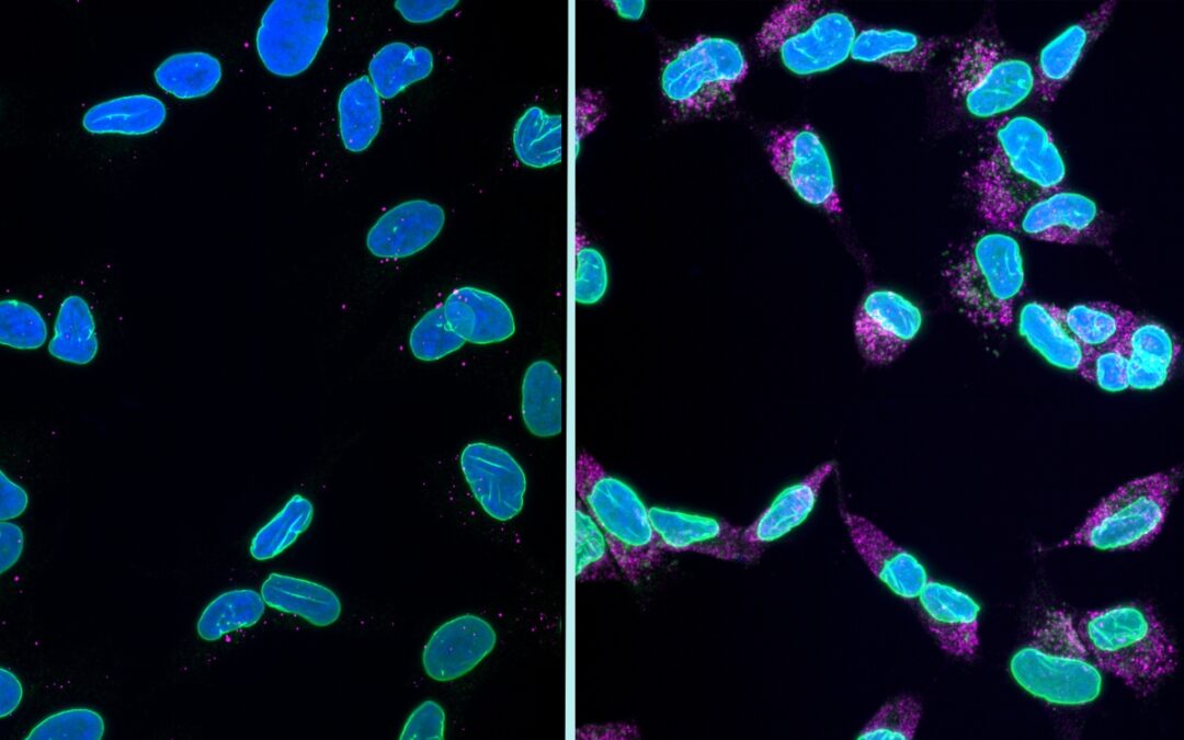 New Research Reveals How Toxic Proteins Kill Brain Cells in Dementia