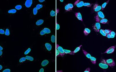 New Research Reveals How Toxic Proteins Kill Brain Cells in Dementia