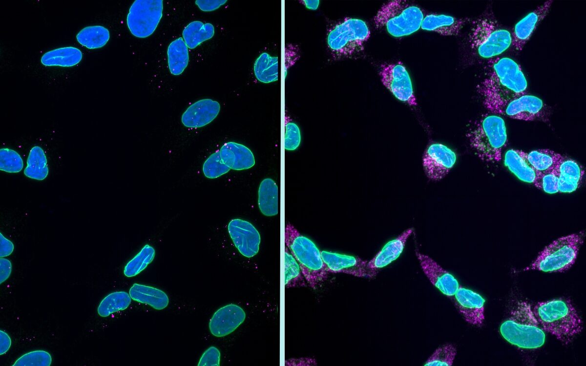 Fluorescence microscopy comparing healthy neurons and karyoptosis dementia cells with fragmented nuclei under toxic protein stress